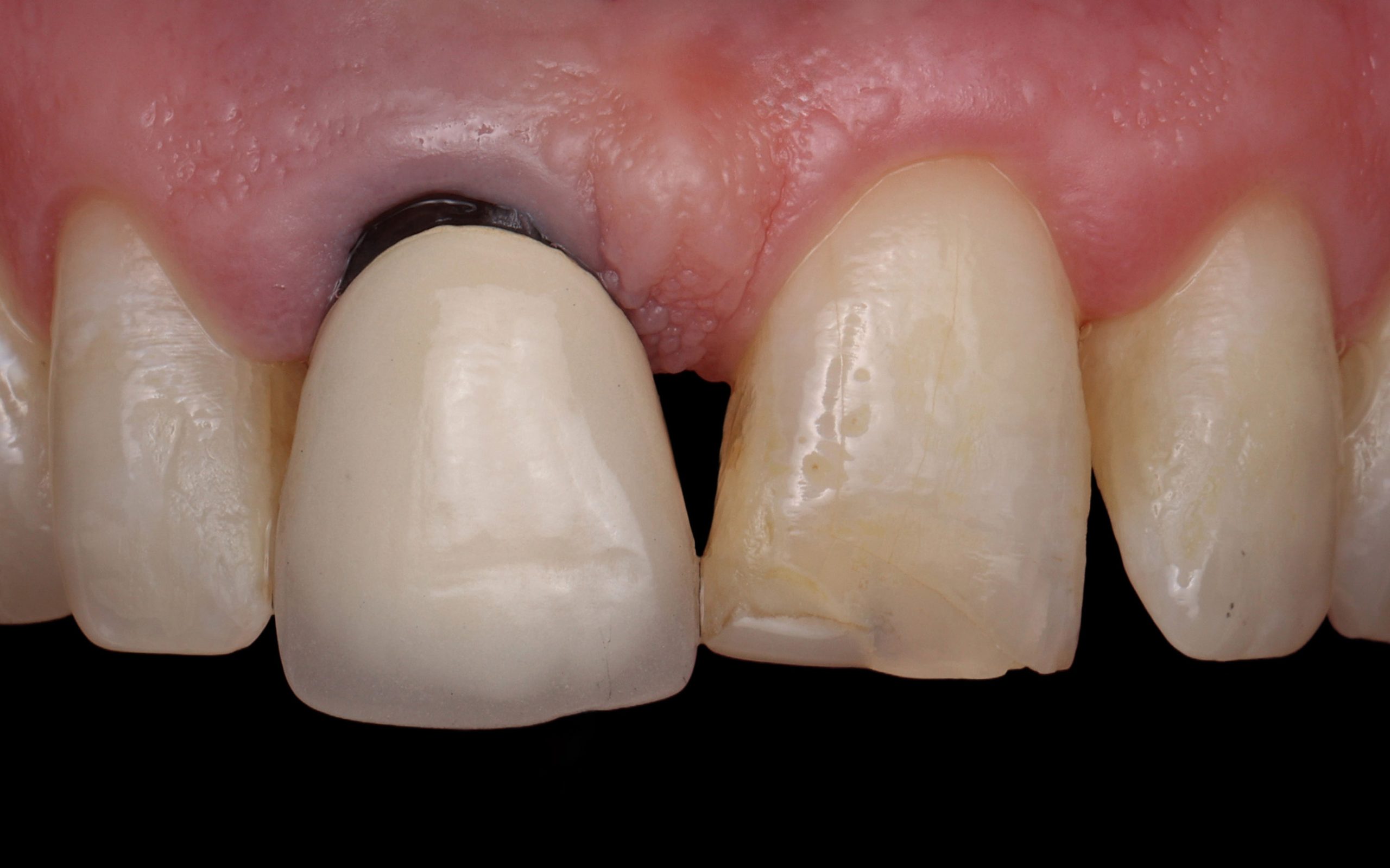 Before and After Dental Implants