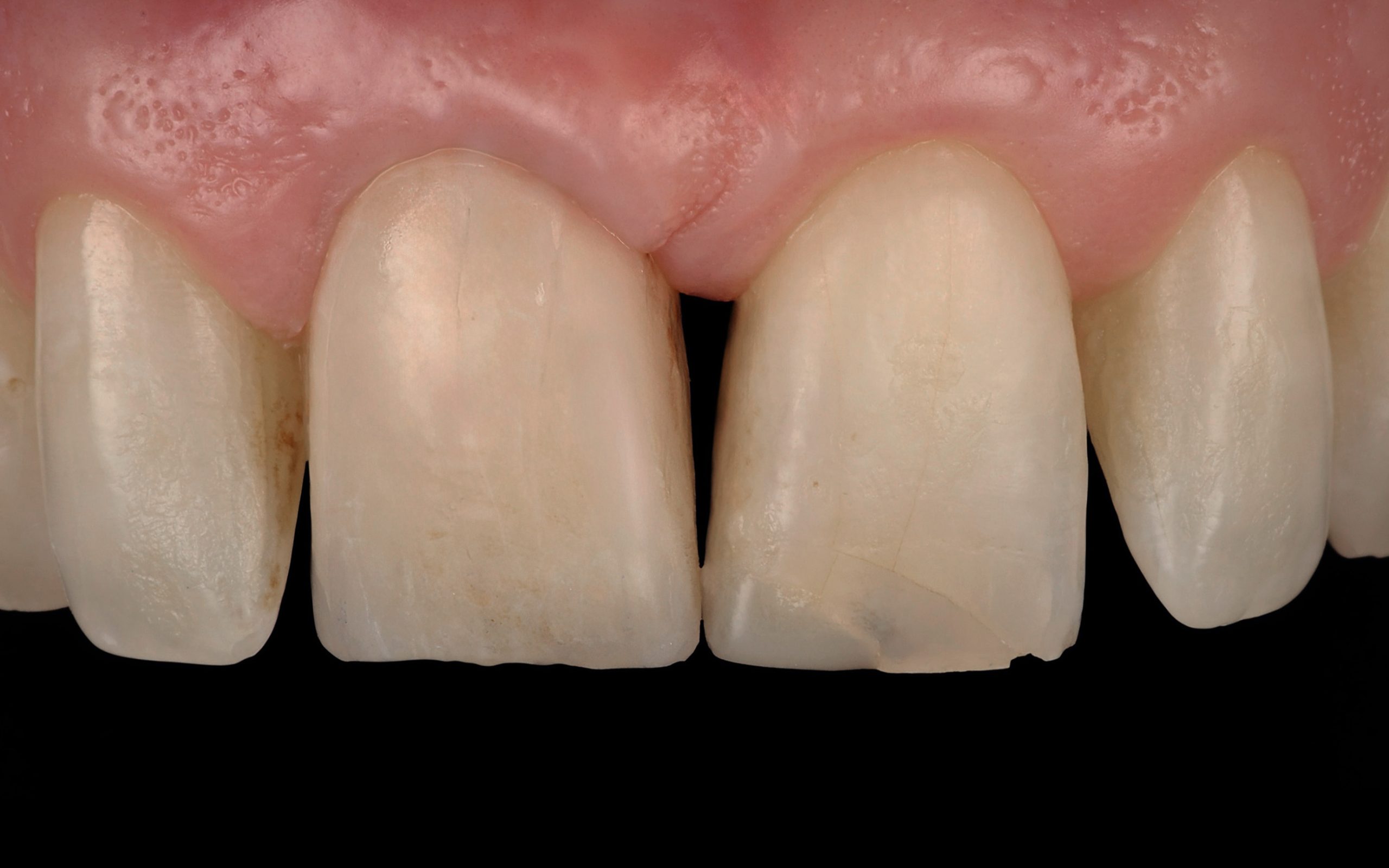 Before and After Dental Implants