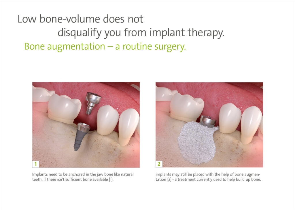Bone graft for dental implants.