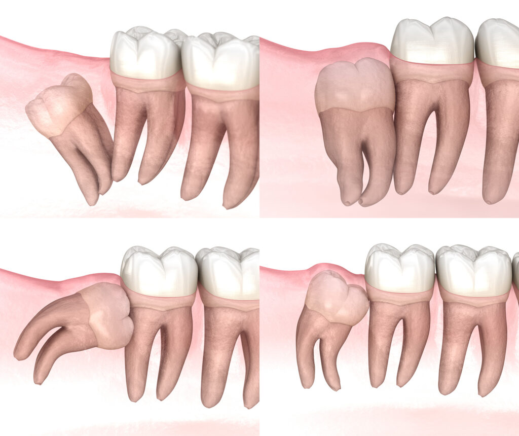 impacted wisdom tooth removal near me