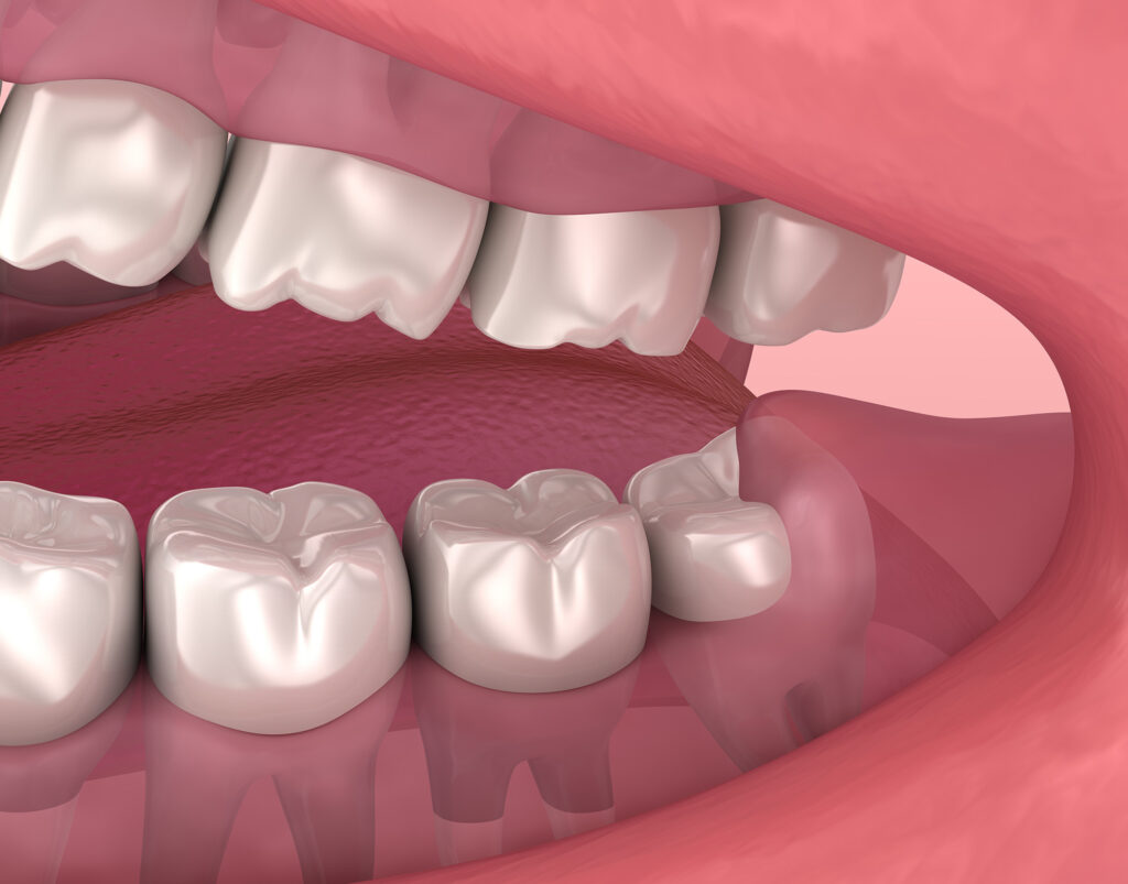 impacted wisdom teeth removal near me