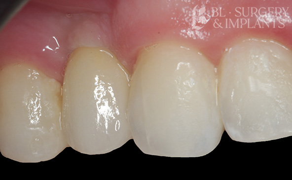 Before and After Dental Implants