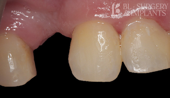 Before and After Dental Implants