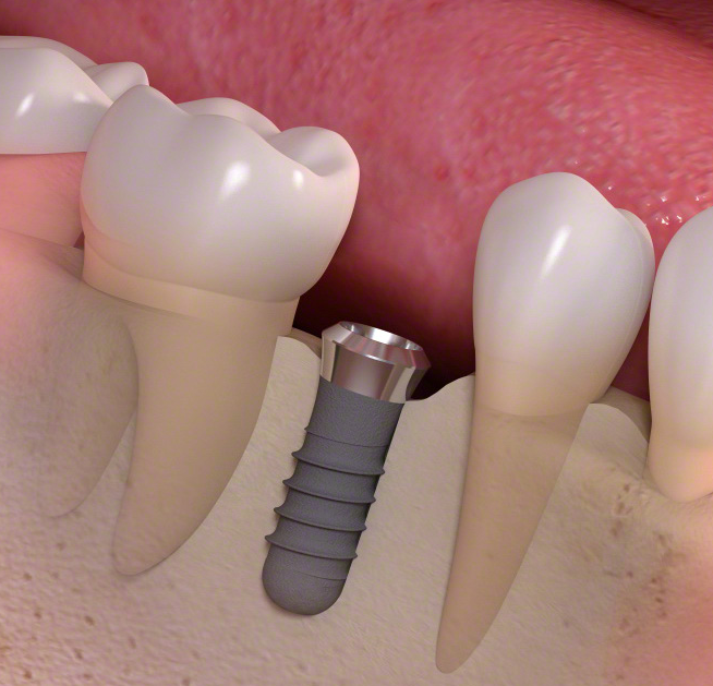 Best dental implants