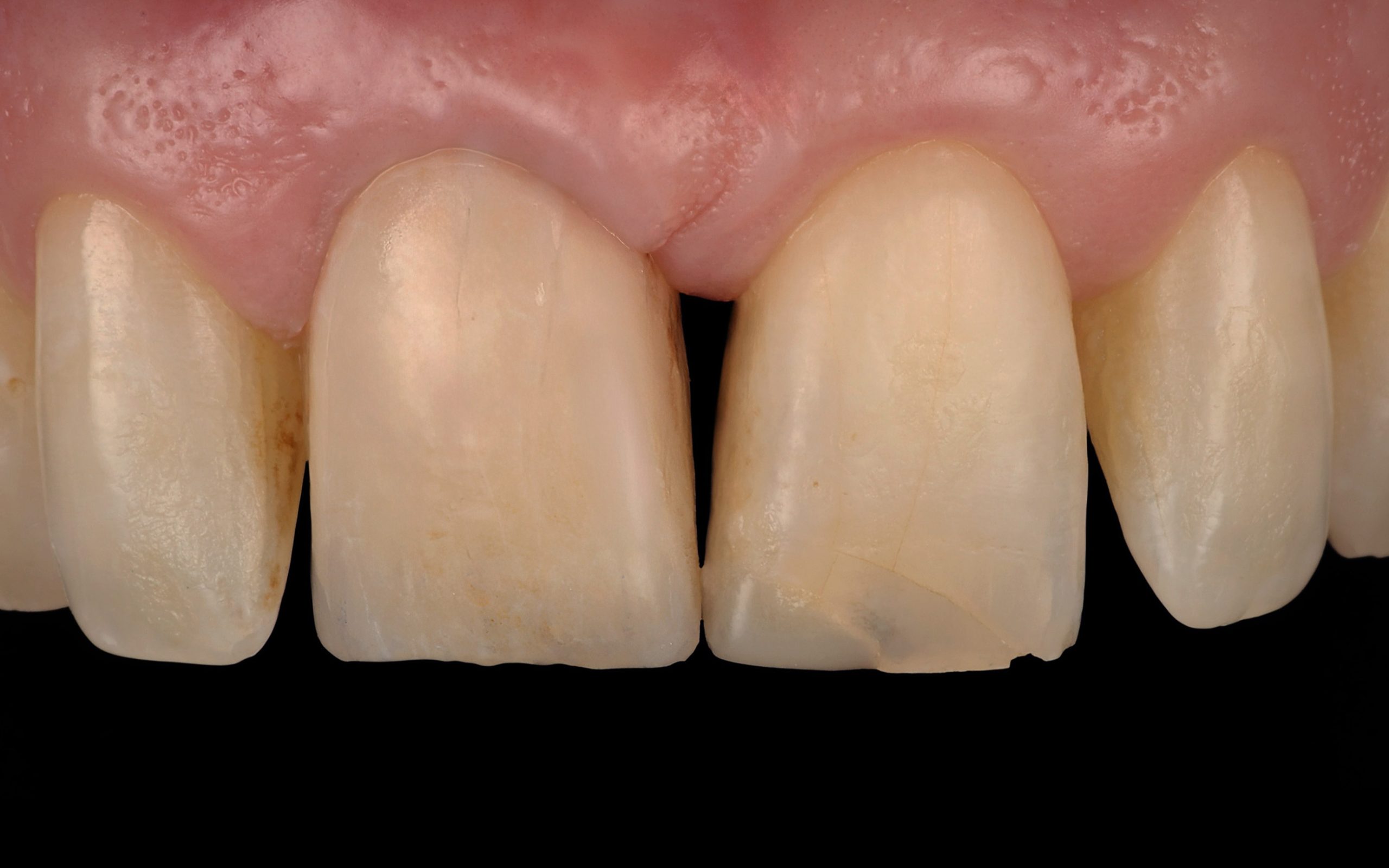 Before and After Dental Implants
